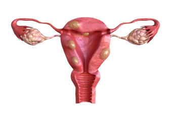 Important Facts About Fibroids